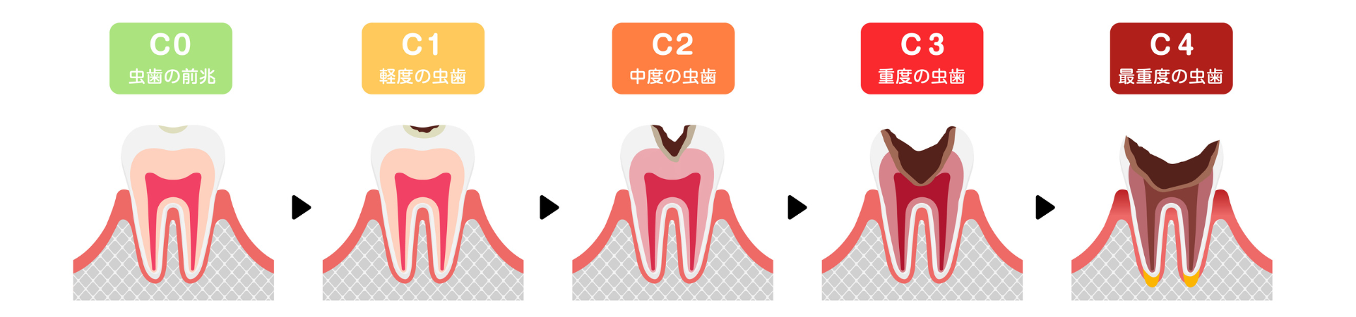 虫歯の進行|しろきデンタル