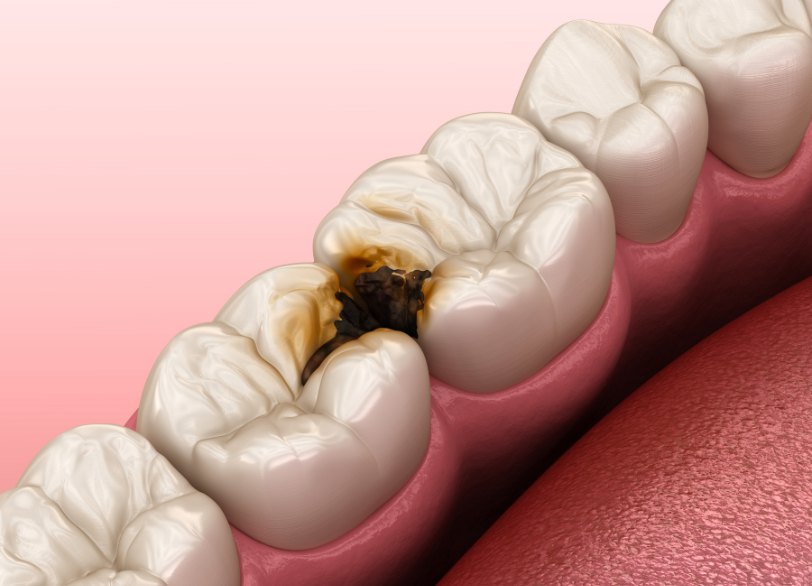 なぜ虫歯になったのか|しろきデンタル