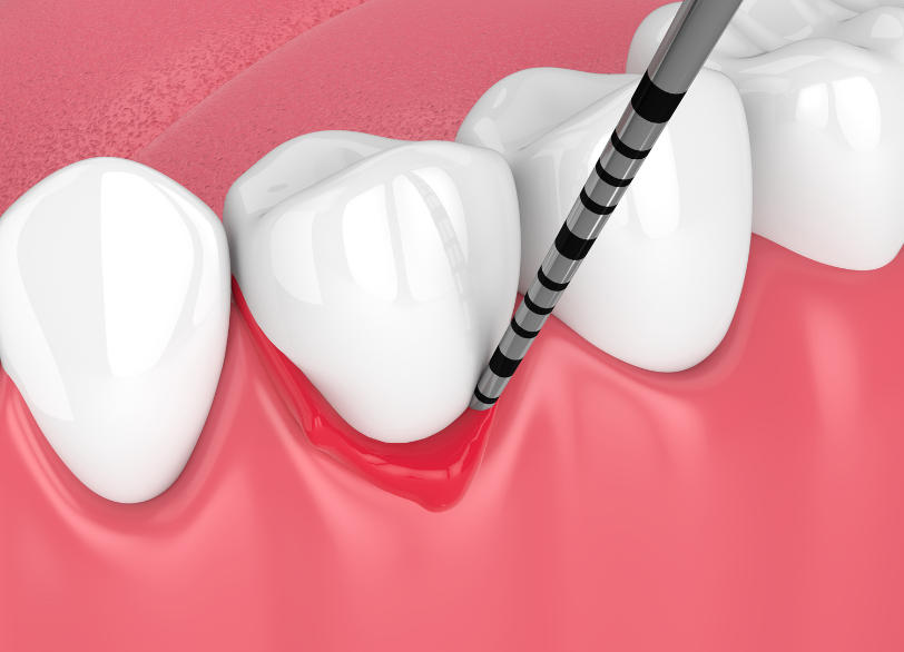 歯周病とは|しろきデンタル