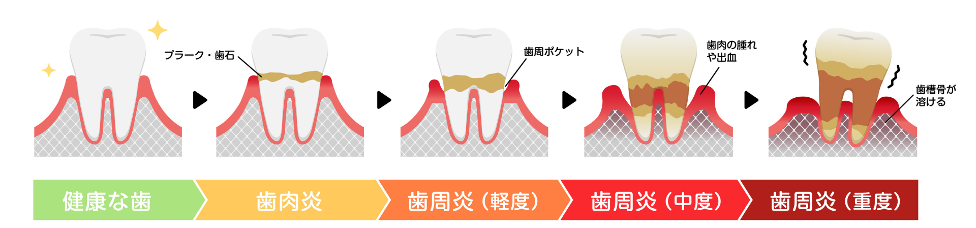 歯周病の進行|しろきデンタル