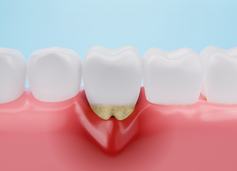 歯茎や骨が失われてしまう理由|しろきデンタル