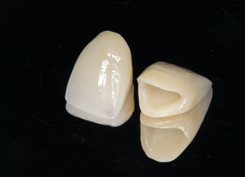 オールセラミック|しろきデンタル