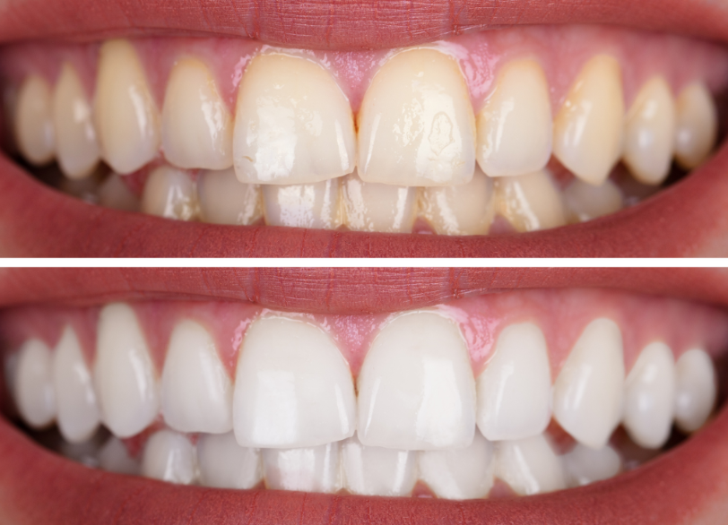 ホワイトニング|しろきデンタル