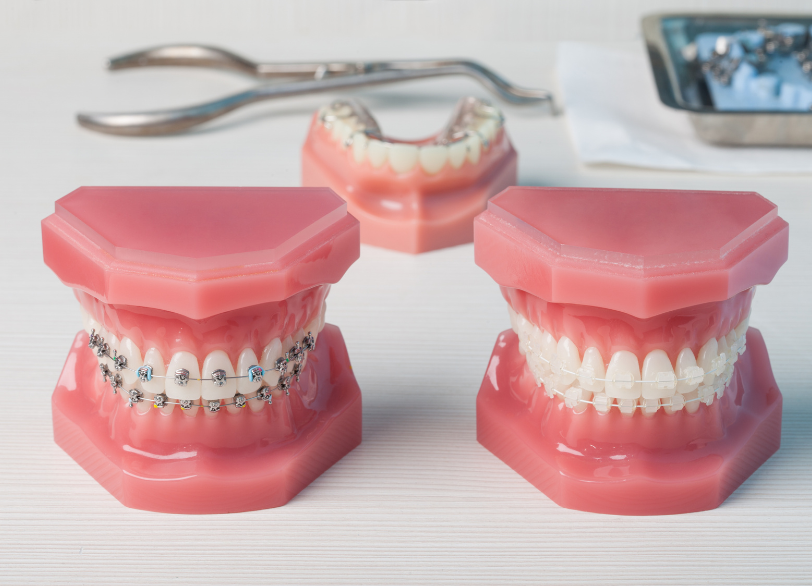 ワイヤー矯正|しろきデンタル