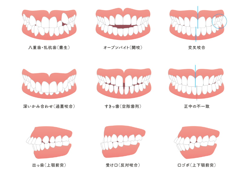噛み合わせ 不正咬合|しろきデンタル