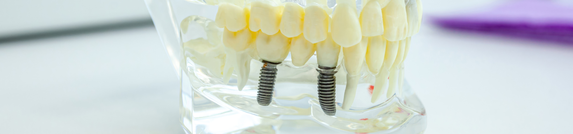 インプラント治療|しろきデンタル