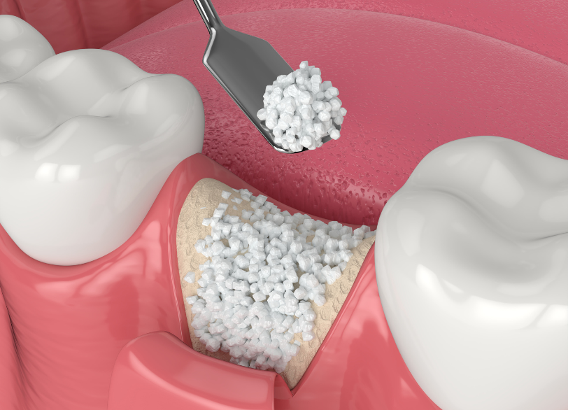 骨造成|しろきデンタル