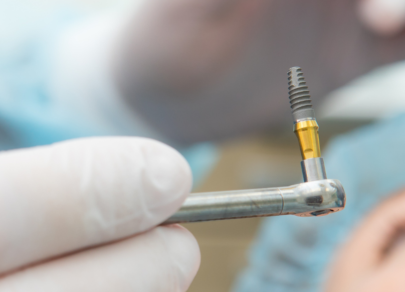 信頼性の高いインプラン|しろきデンタル