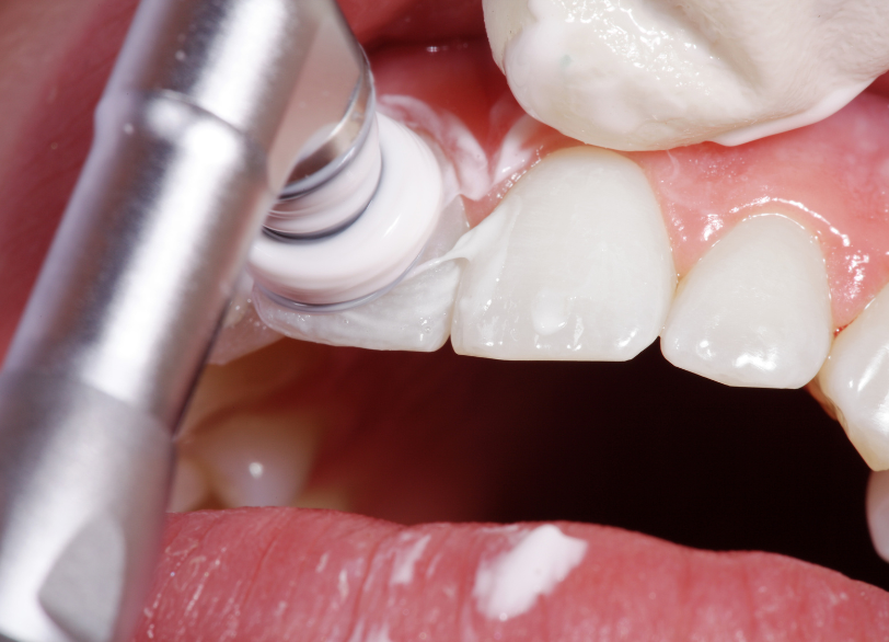 プロフェッショナルケア|しろきデンタル