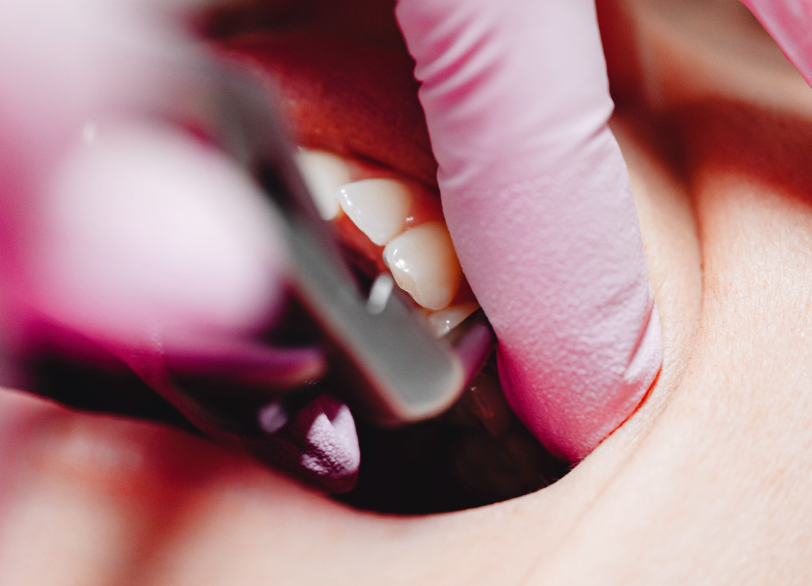 意図的再植術の考慮|しろきデンタル