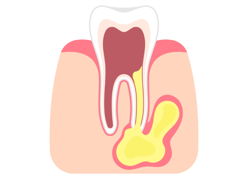根尖性歯周炎|しろきデンタル