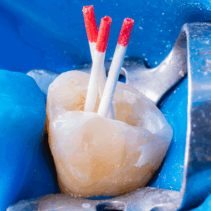 根管充填｜しろきデンタル