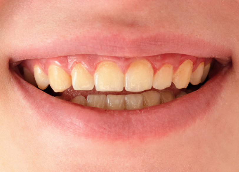 着色・変色の原因|しろきデンタル