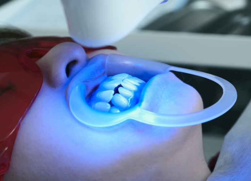 オフィスホワイトニング|しろきデンタル