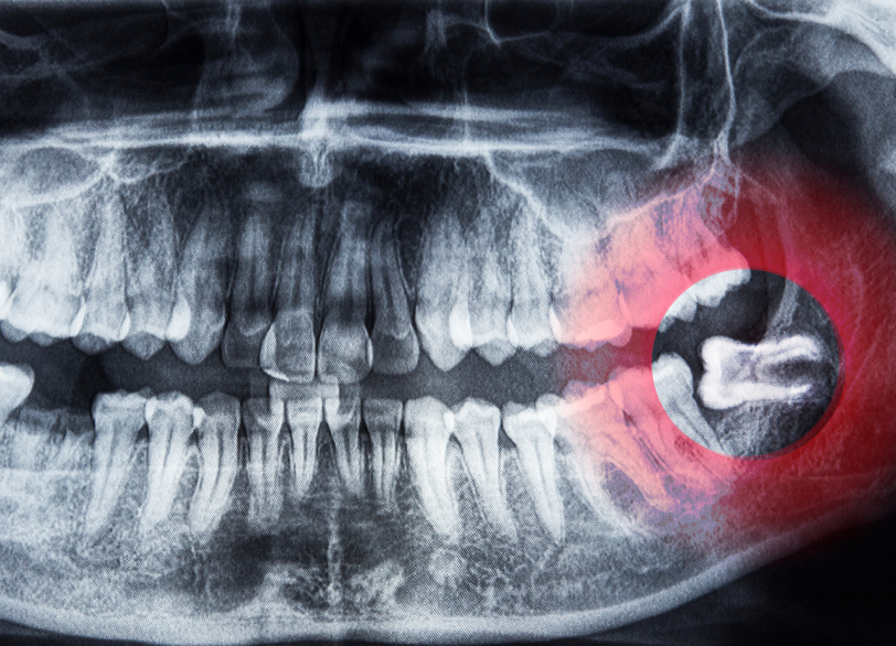 親知らずが引き起こす主なトラブル|しろきデンタル