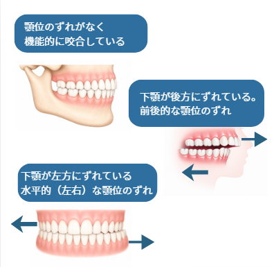 顎位の説明