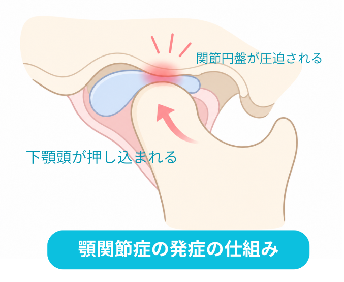 顎関節の音が鳴る仕組み